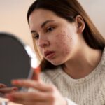 productos acne